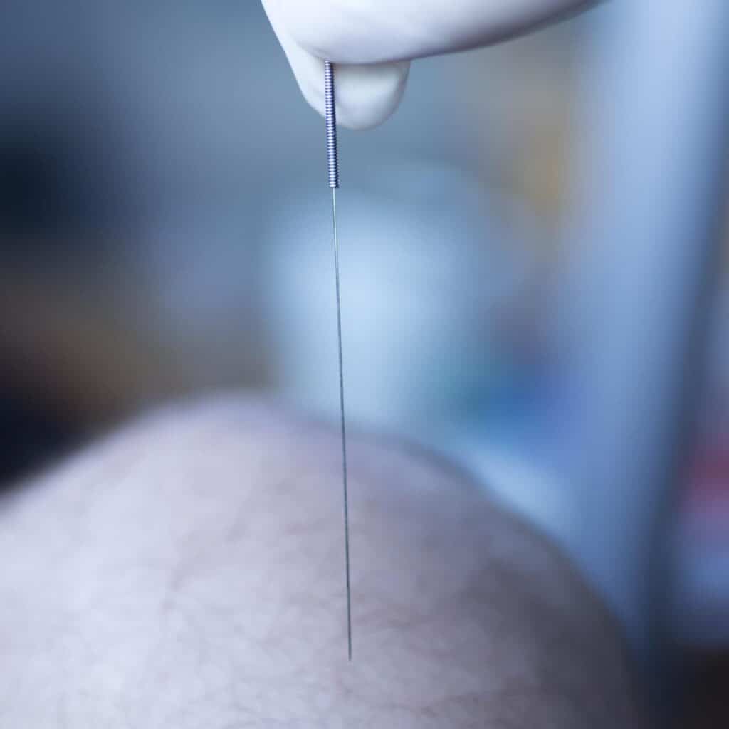 dry needling