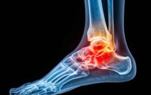 Ankle Pain