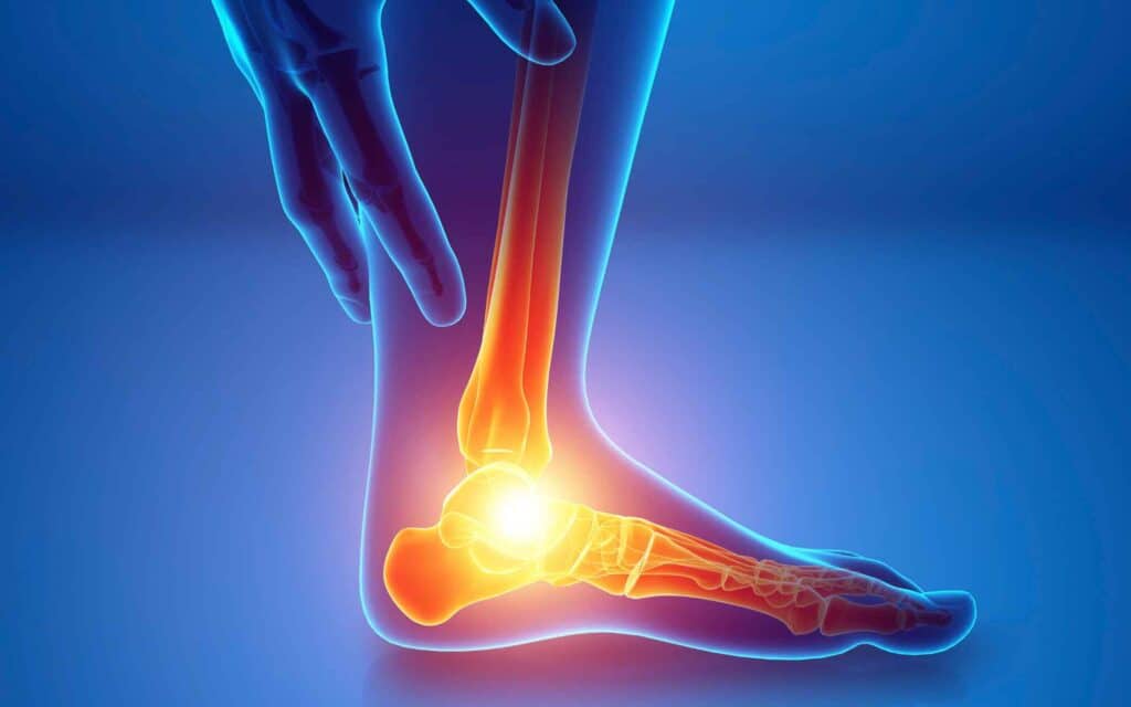 Planter Fasciitis